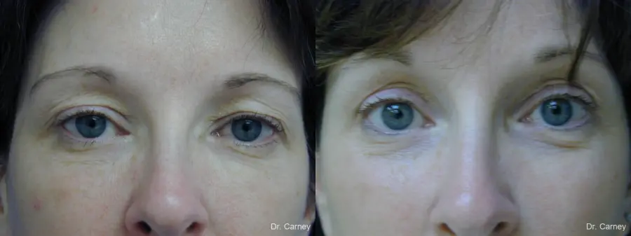 Virginia Beach Brow Lift 1217 - Before and After 2