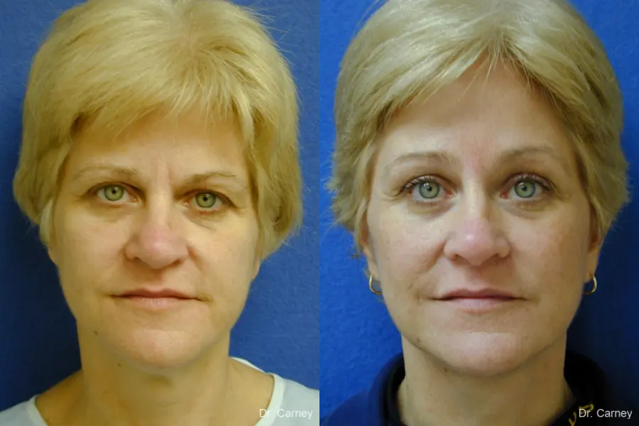 Virginia Beach Brow Lift 1345 - Before and After 2