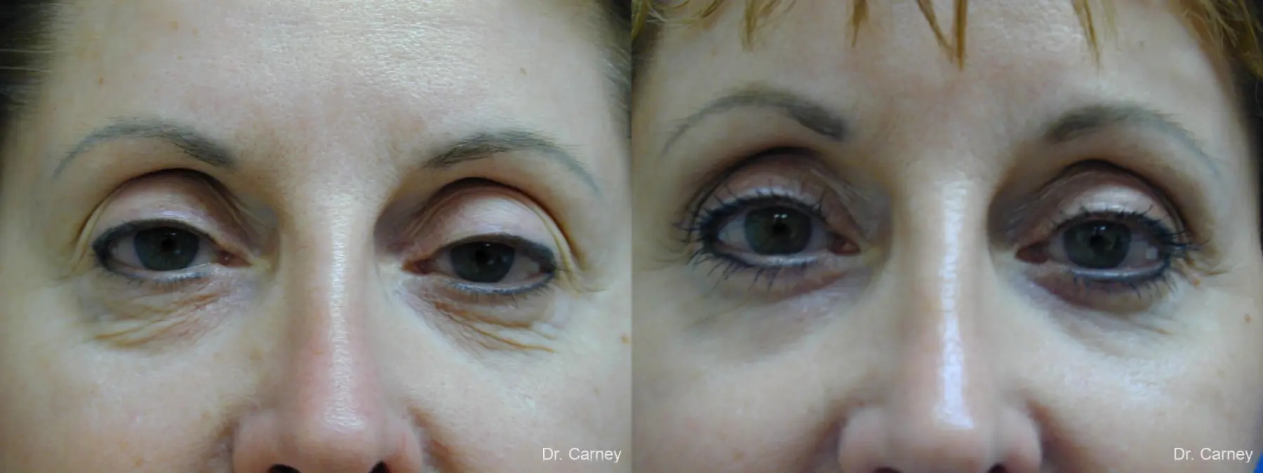 Virginia Beach Brow Lift 1216 - Before and After 4
