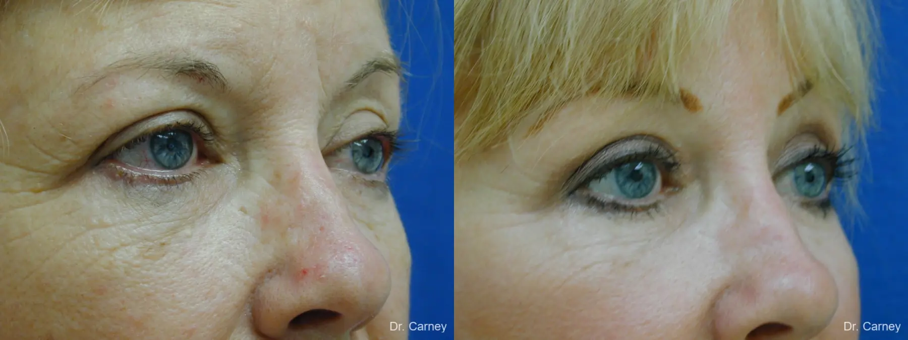Virginia Beach Brow Lift 1266 - Before and After 2