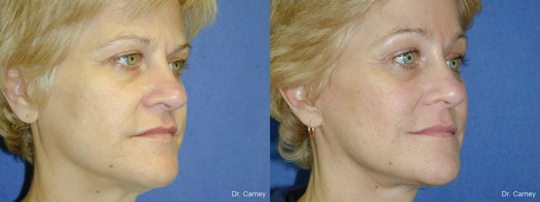 Virginia Beach Brow Lift 1345 - Before and After