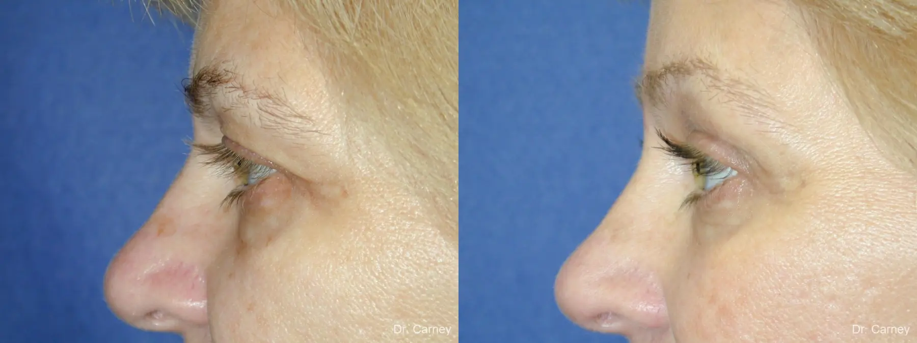 Virginia Beach Brow Lift 1345 - Before and After 5