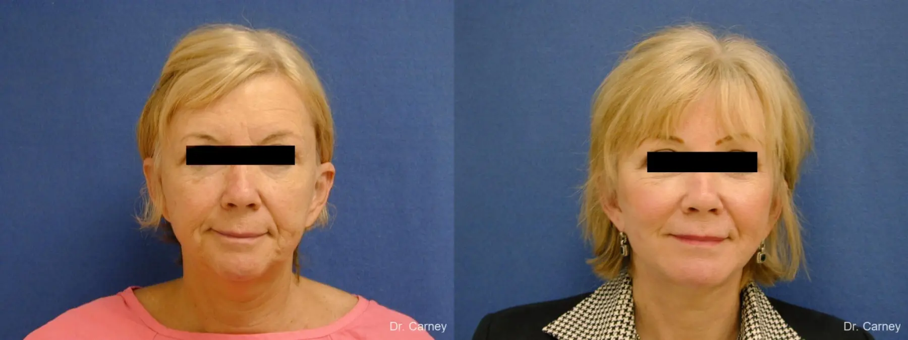 Virginia Beach Brow Lift 1266 - Before and After 5