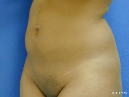 Virginia Beach Liposuction 1283 - Before Image 3