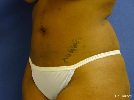 Virginia Beach Liposuction 1283 - After Image 3