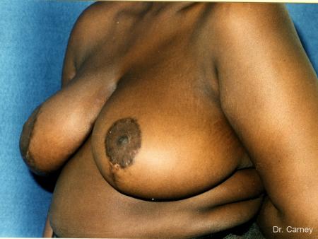 Virginia Beach Breast Reduction 1233 - After Image 1