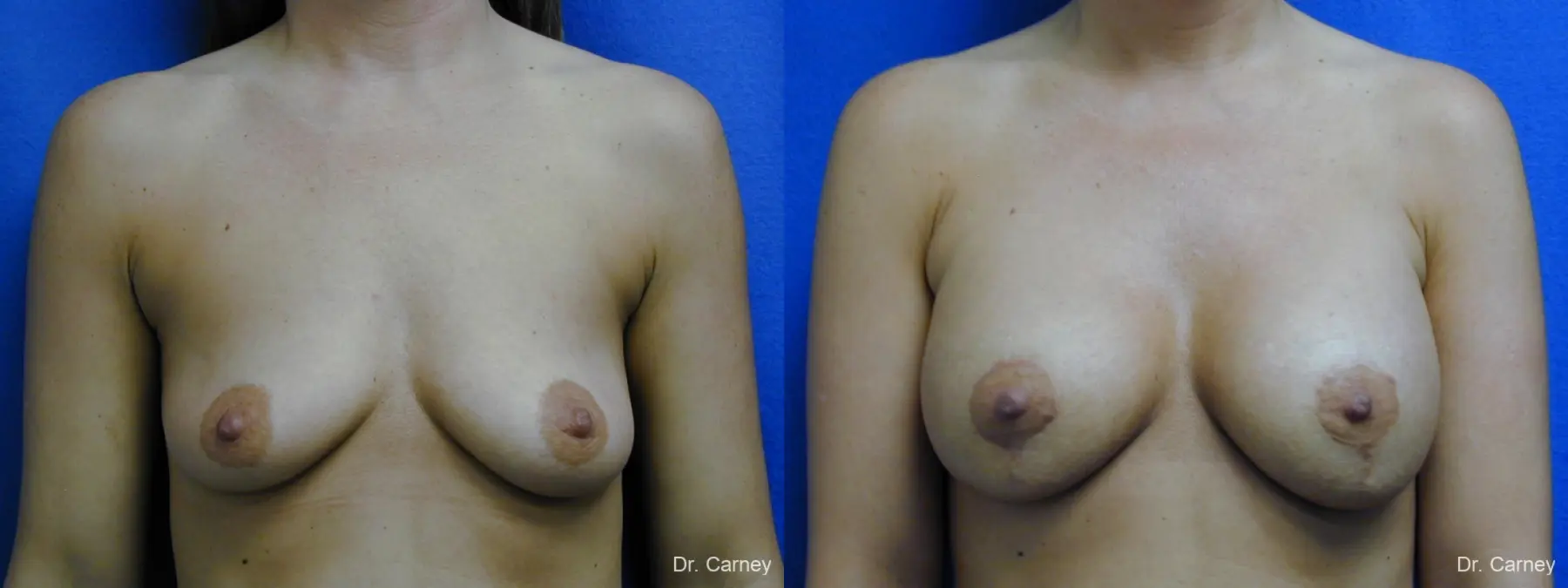 Virginia Beach Combo Procedures Breast 1096 - Before and After 3