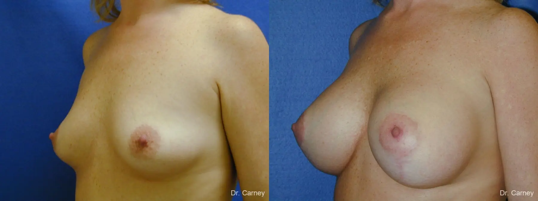 Virginia Beach Combo Procedures Breast 1093 - Before and After 1
