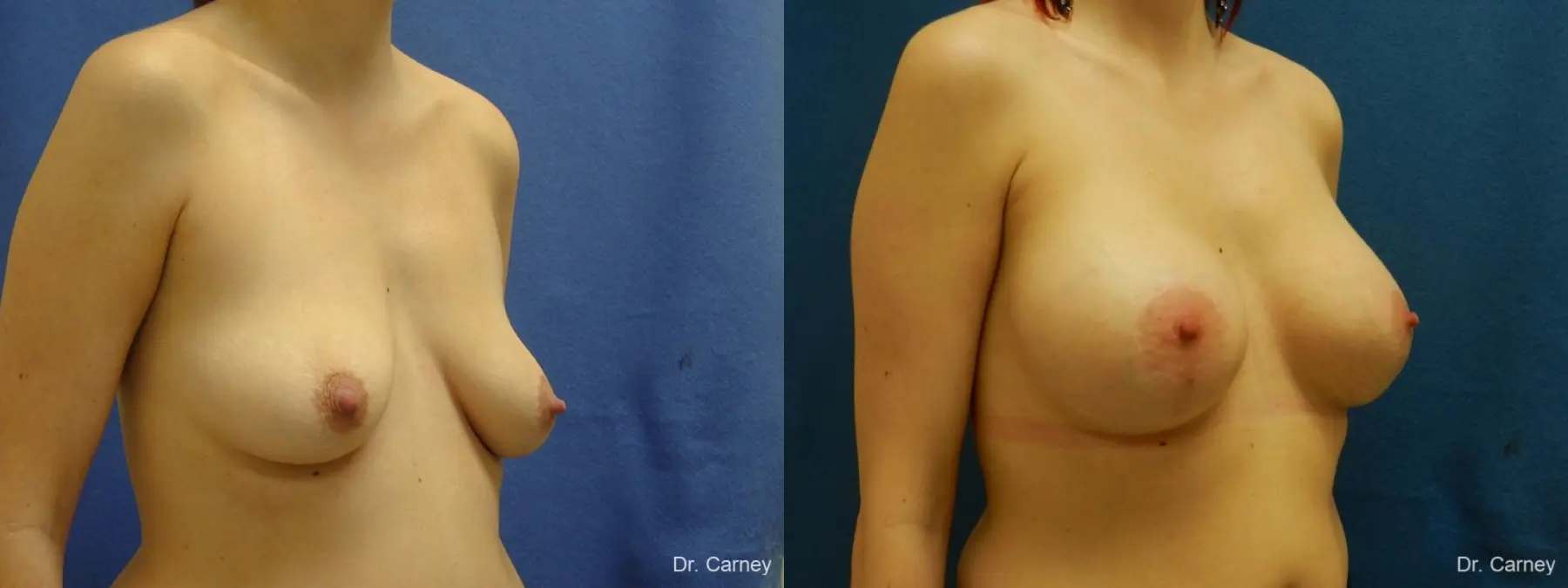 Virginia Beach Combo Procedures Breast 1182 - Before and After 2