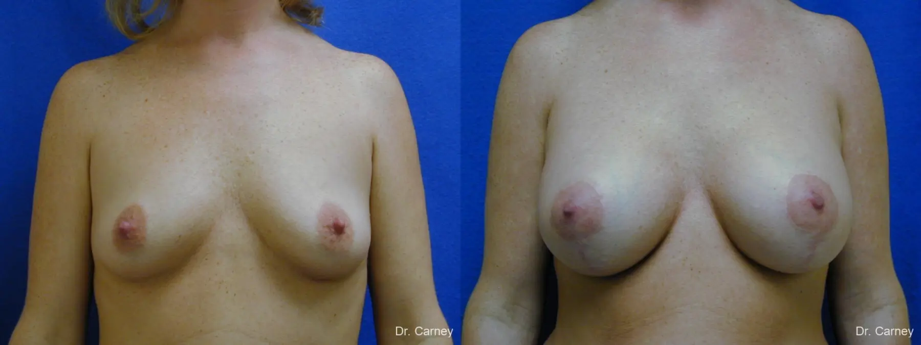 Virginia Beach Combo Procedures Breast 1093 - Before and After 2