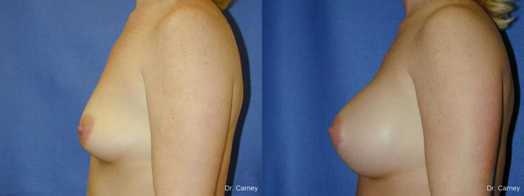 Virginia Beach Combo Procedures Breast 1093 - Before and After 3