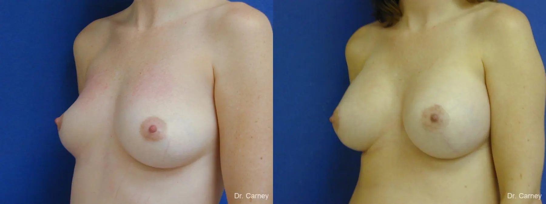 Virginia Beach Combo Procedures Breast 1095 - Before and After 2