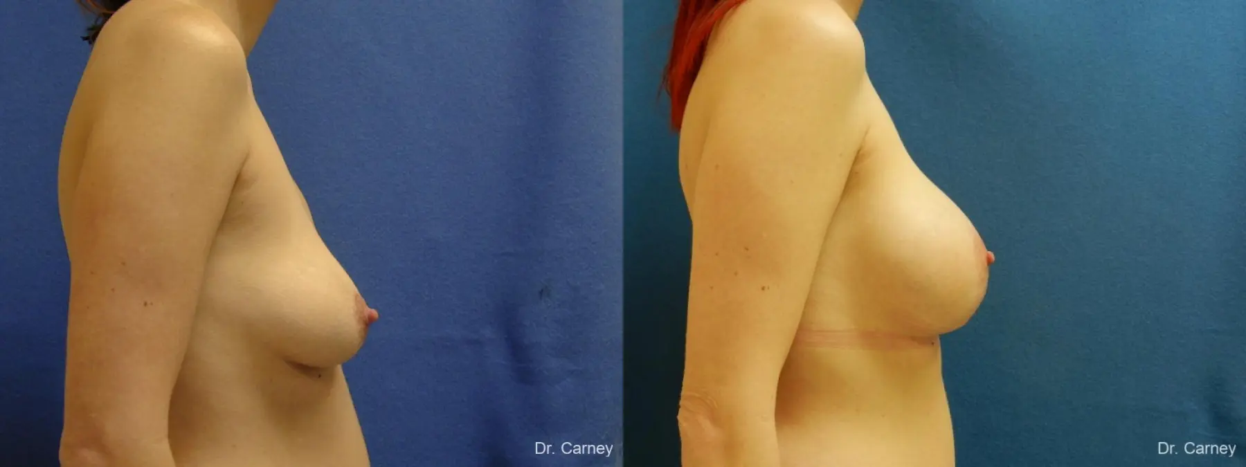 Virginia Beach Combo Procedures Breast 1182 - Before and After 3