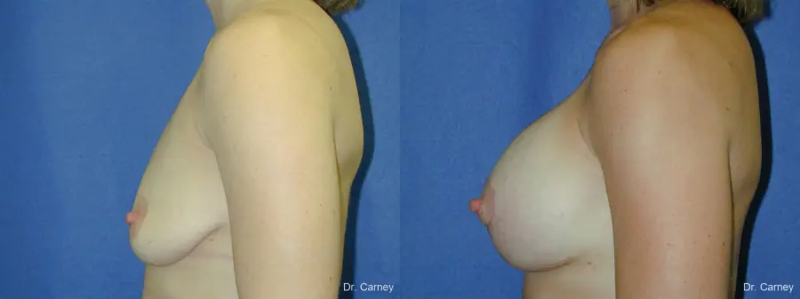 Virginia Beach Combo Procedures Breast 1099 - Before and After 2