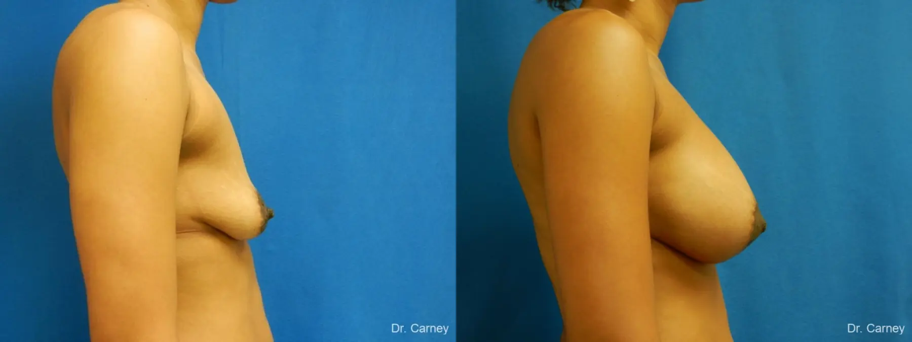 Virginia Beach Combo Procedure Breast 1861 - Before and After 3
