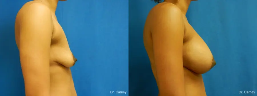Virginia Beach Combo Procedure Breast 1861 - Before and After 3