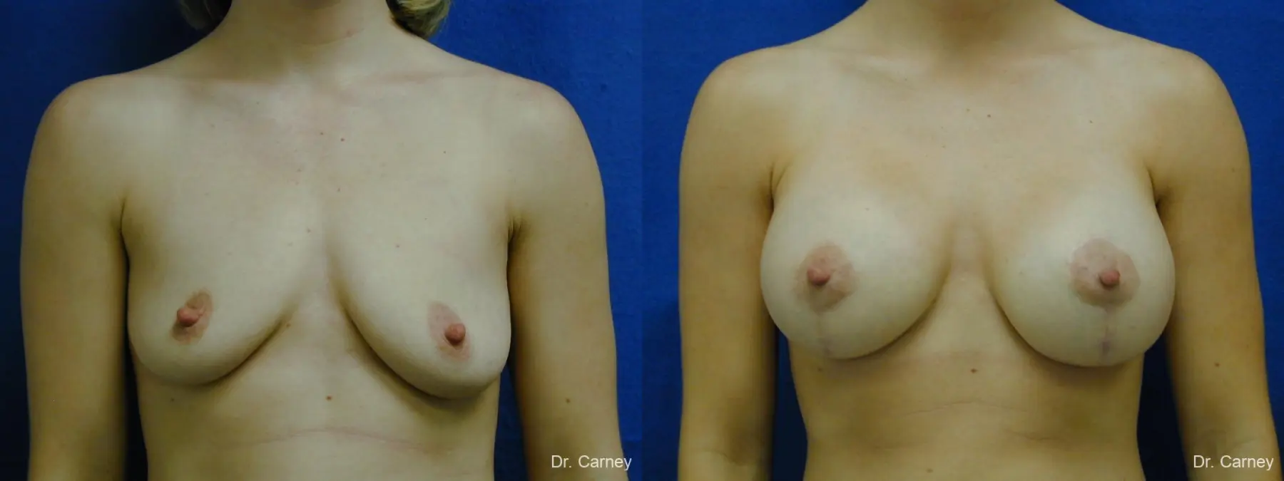 Virginia Beach Combo Procedures Breast 1099 - Before and After 1