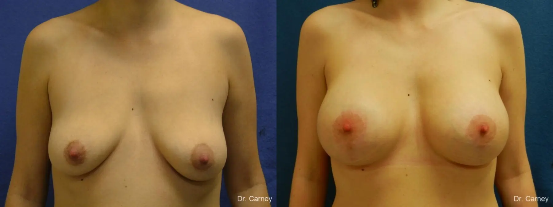 Virginia Beach Combo Procedures Breast 1182 - Before and After 1