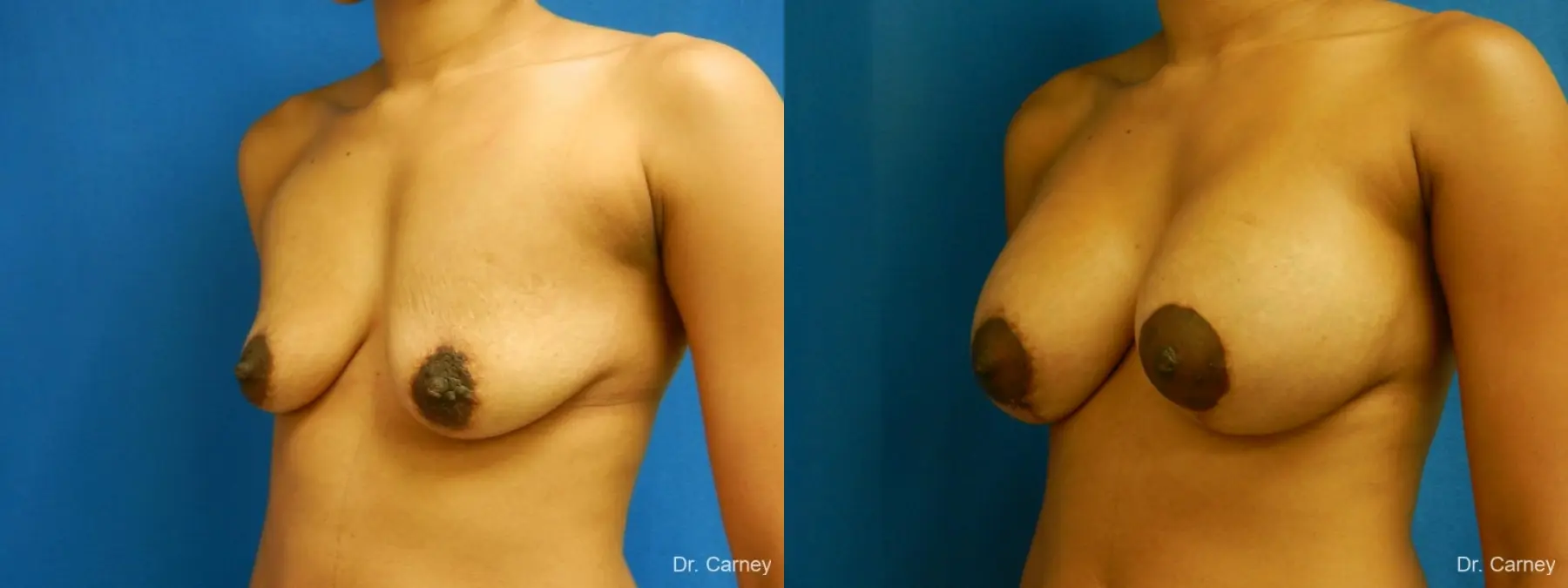 Virginia Beach Combo Procedure Breast 1861 - Before and After 4