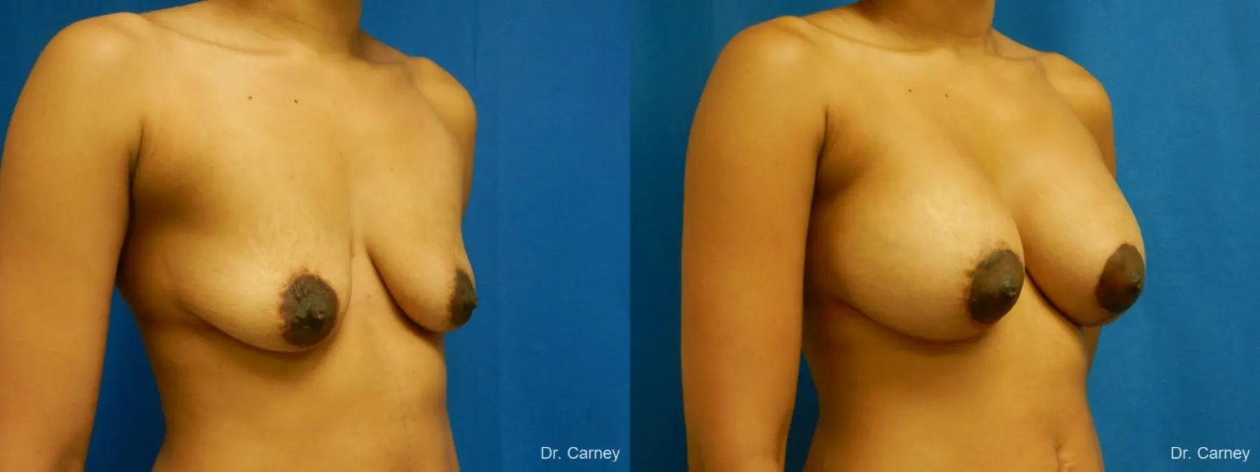 Virginia Beach Combo Procedure Breast 1861 - Before and After 2