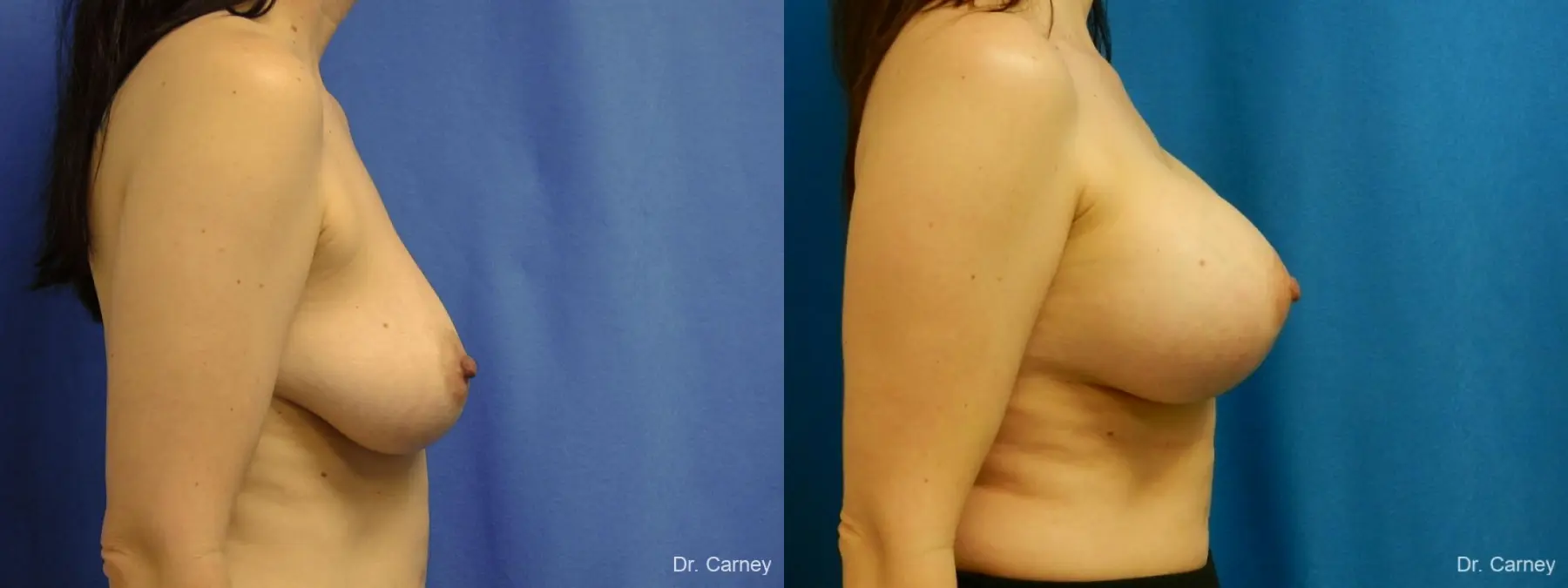 Virginia Beach Combo Procedure Breast 1184 - Before and After 3