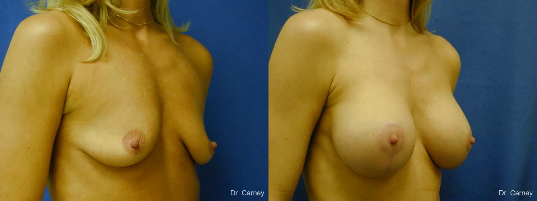 Virginia Beach Combo Procedures Breast 1094 - Before and After