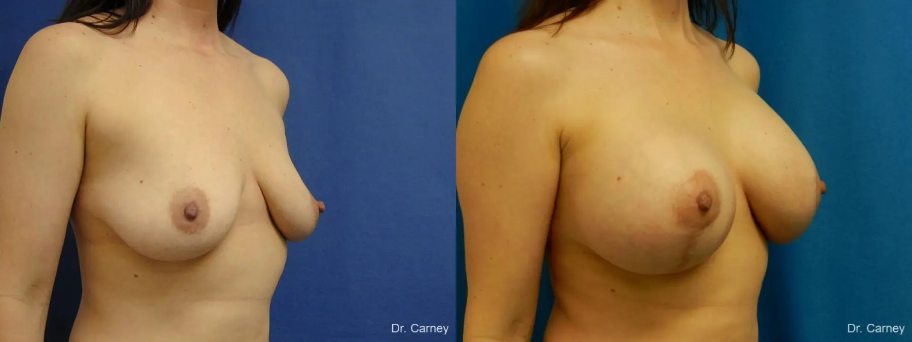 Virginia Beach Combo Procedure Breast 1184 - Before and After 2
