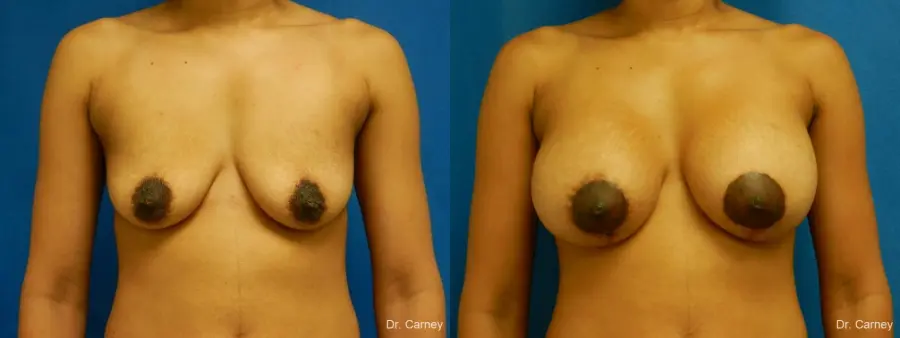 Virginia Beach Combo Procedure Breast 1861 - Before and After 1
