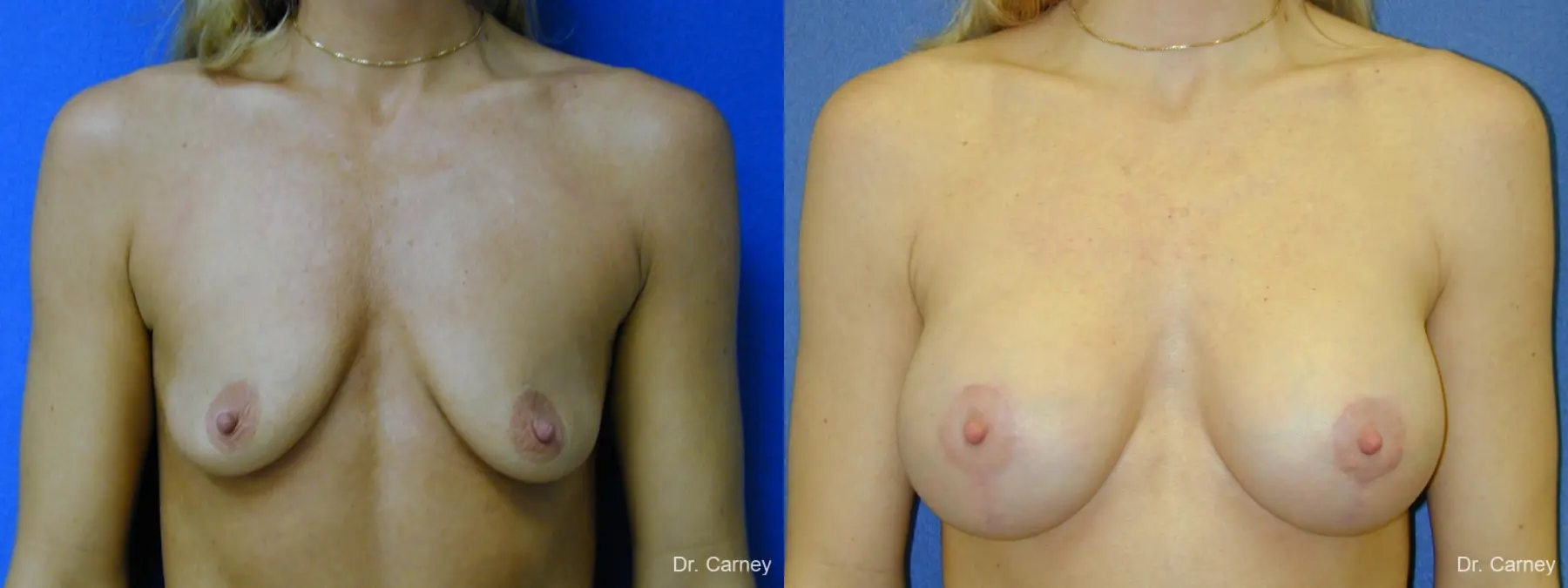 Virginia Beach Combo Procedures Breast 1094 - Before and After 2