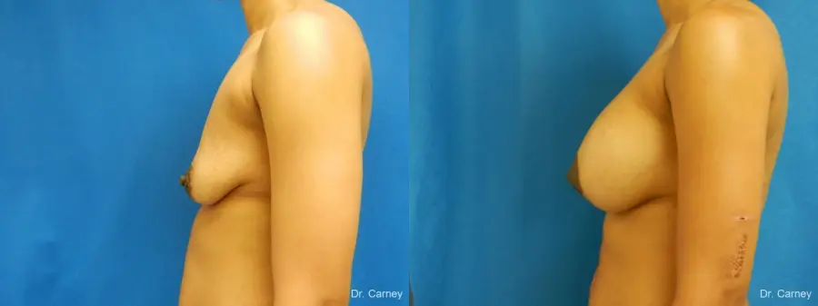 Virginia Beach Combo Procedure Breast 1861 - Before and After 5