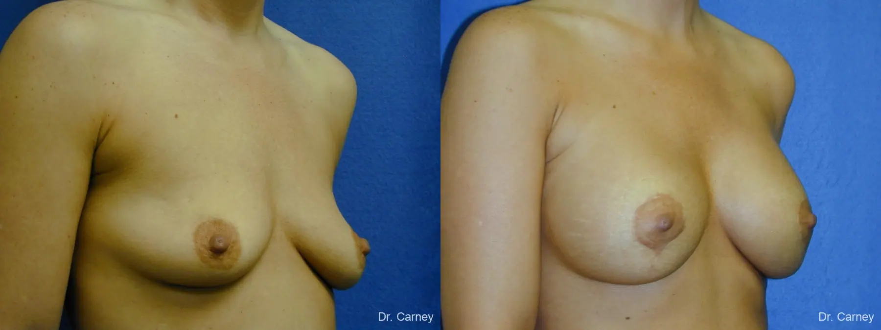 Virginia Beach Combo Procedures Breast 1096 - Before and After