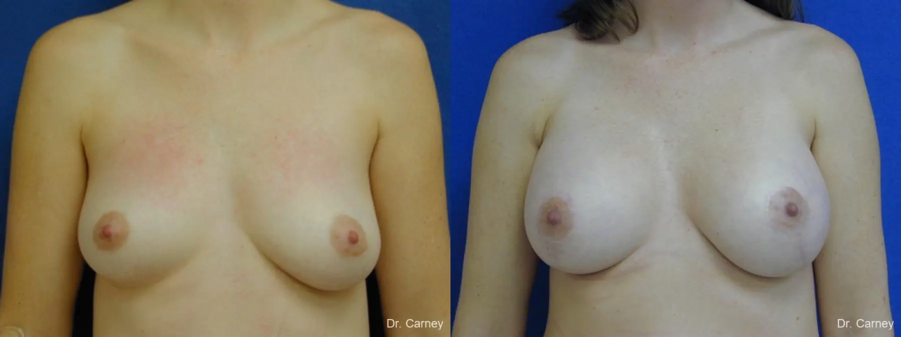 Virginia Beach Combo Procedures Breast 1095 - Before and After 1
