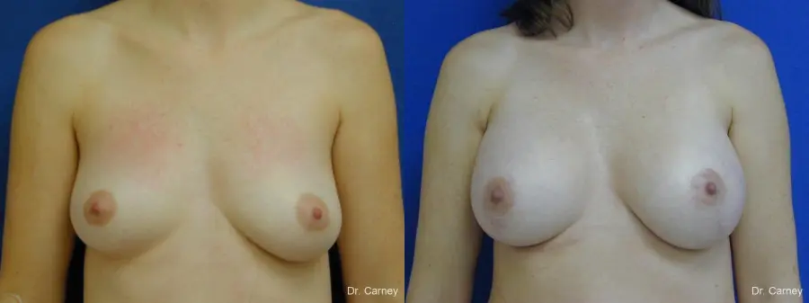 Virginia Beach Combo Procedures Breast 1095 - Before and After 1