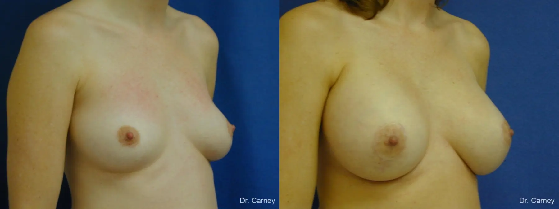 Virginia Beach Combo Procedures Breast 1095 - Before and After 3