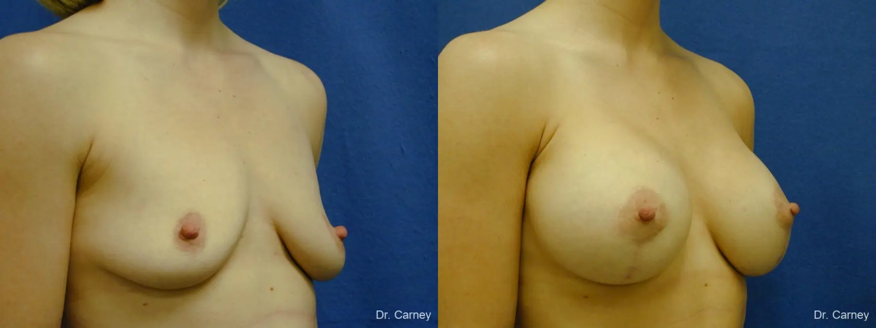 Virginia Beach Combo Procedures Breast 1099 - Before and After 3