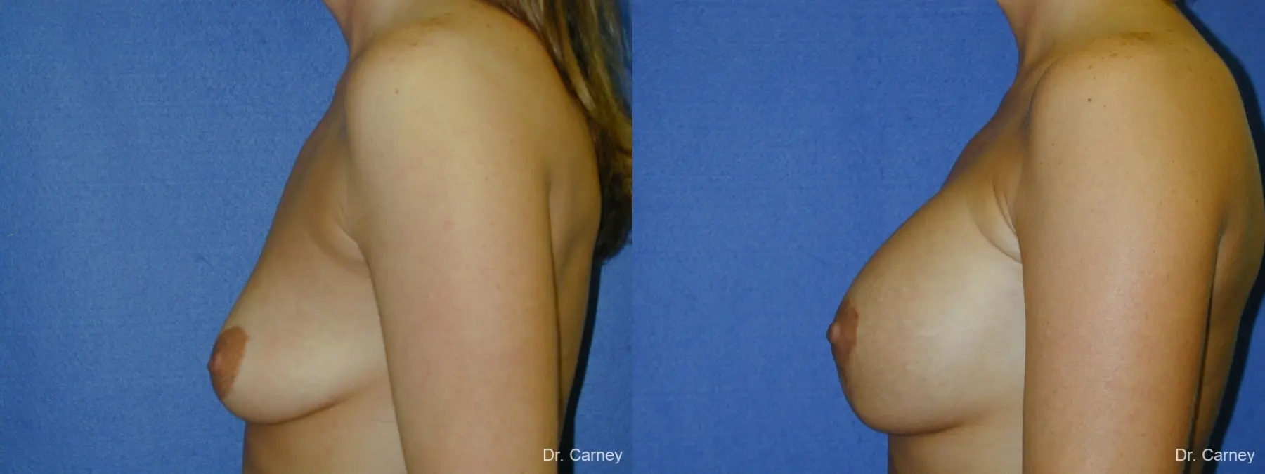 Virginia Beach Combo Procedures Breast 1096 - Before and After 2