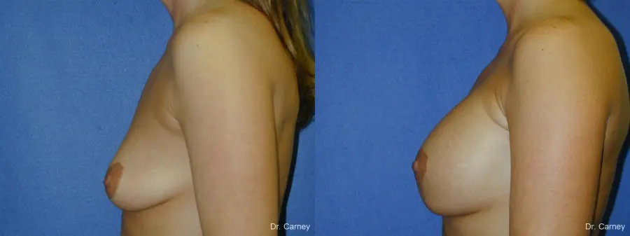 Virginia Beach Combo Procedures Breast 1096 - Before and After 2