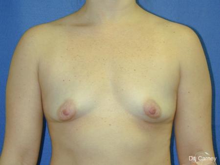 Virginia Beach Breast Augmentation 1083 - Before and After Image 3