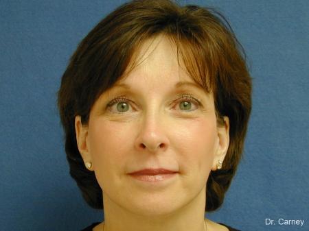Virginia Beach Brow Lift 1217 - After Image 1