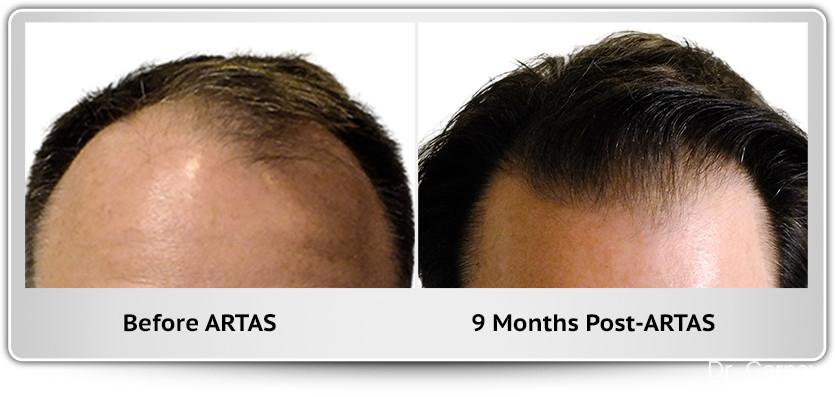 Hair Transplantation: Patient 7 - Before and After Image 1