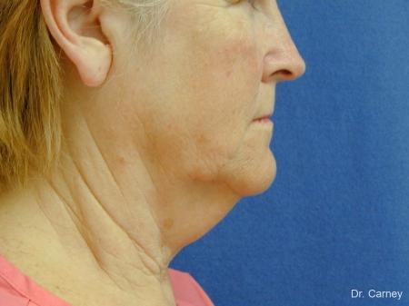 Virginia Beach Neck Lift 1207 - Before Image 2