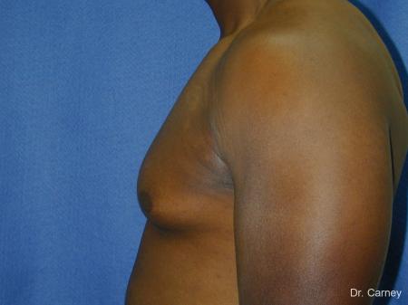 Virginia Beach Gynecomastia 1226 - Before and After Image 5