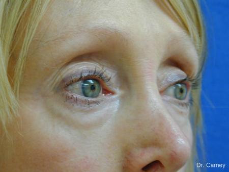 Virginia Beach Eyelid Lift 1079 - Before and After Image 2