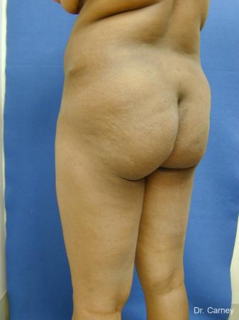 Virginia Beach Brazilian Butt Lift 1220 - Before and After Image 5