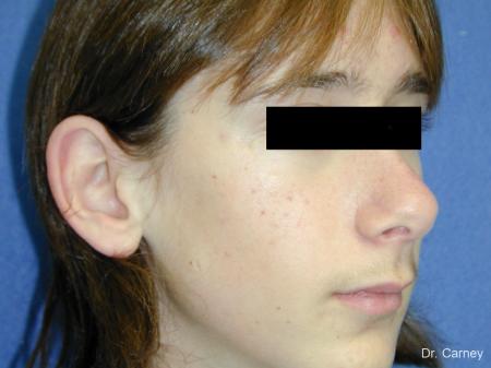 Virginia Beach Otoplasty Earlobe Repair 1271 - Before Image 2