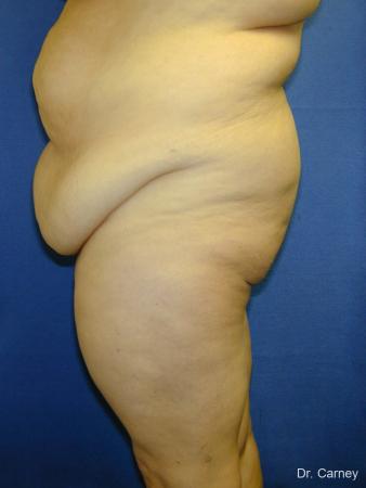 Virginia Beach Tummy Tuck 1250 - Before and After Image 2