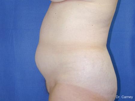 Virginia Beach Liposuction 1213 - Before Image 2