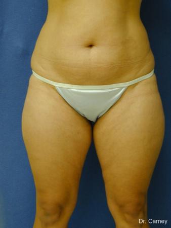Virginia Beach Liposuction 1284 - Before Image 1