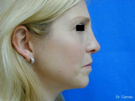 Virginia Beach Rhinoplasty 1343 - After Image 4