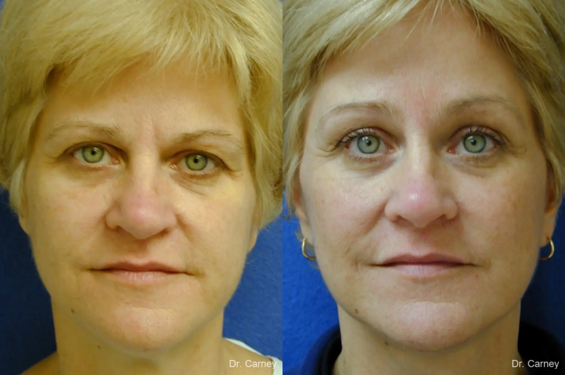 Virginia Beach Eyelid Lift 1344 - Before and After 1